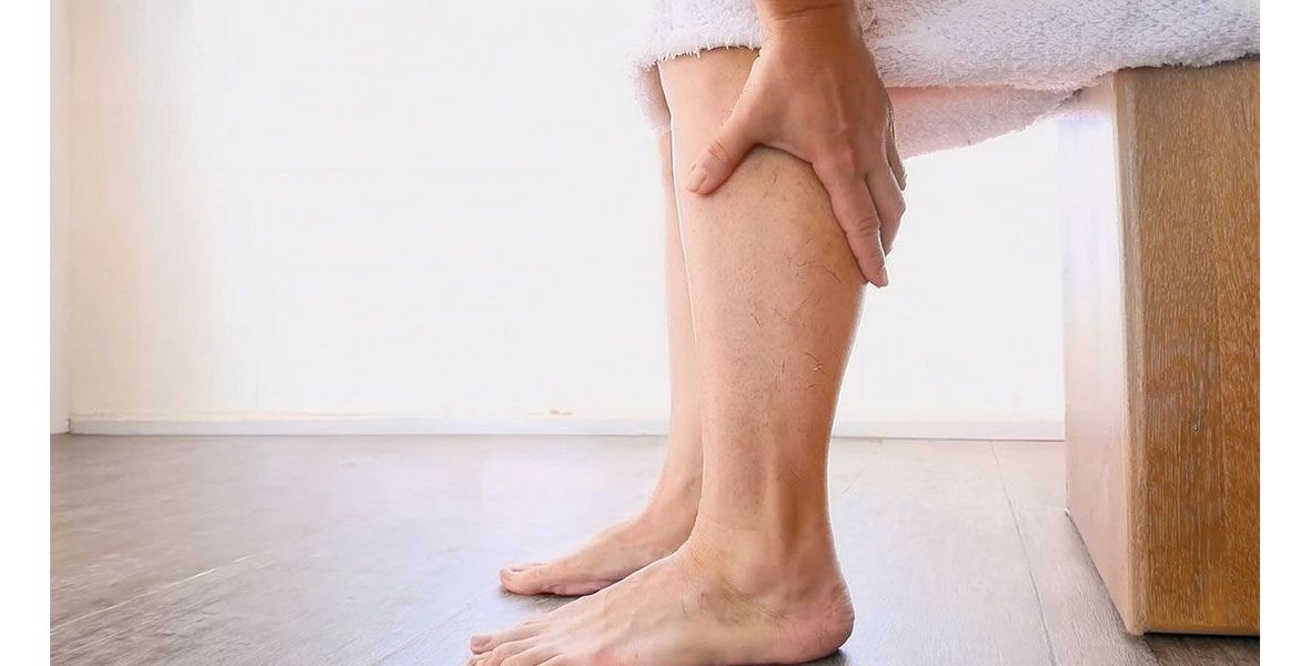 Tratamiento de las varices, los venotónicos