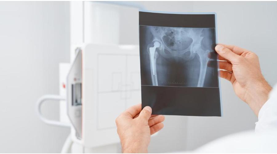 Radiografía Artrosis de cadera
